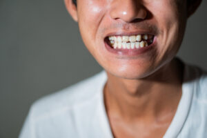 pasang gigi palsu