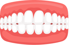 Cross Bite