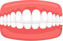 Overbite