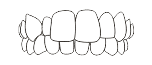 Crossbite