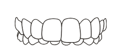 Overbite