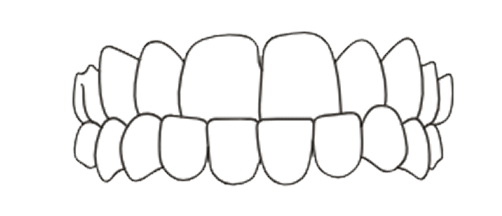 Underbite